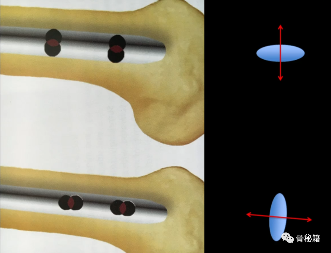 练好髓内钉必备小技巧，做一个优秀的骨科医生！