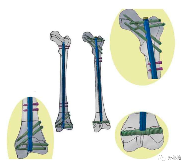 练好髓内钉必备小技巧，做一个优秀的骨科医生！