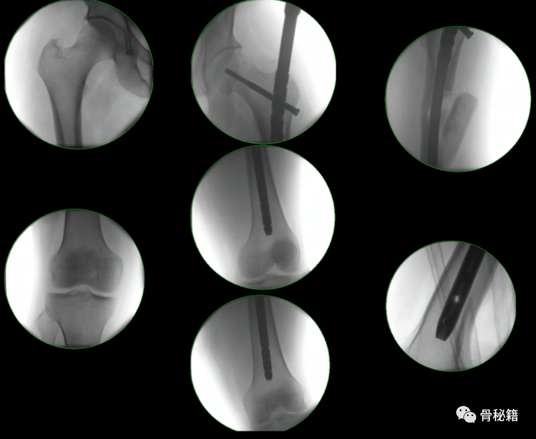 练好髓内钉必备小技巧，做一个优秀的骨科医生！