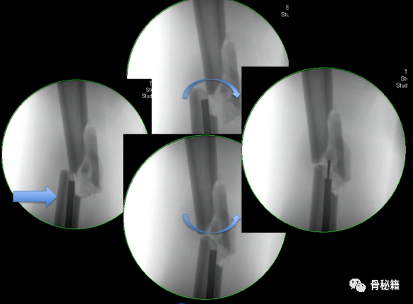 练好髓内钉必备小技巧，做一个优秀的骨科医生！