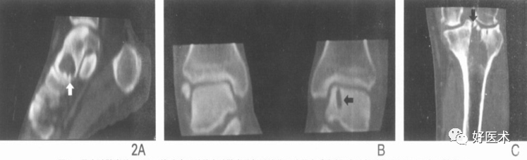 【影像诊断】请注意，腱鞘囊肿不仅仅在腱鞘里！