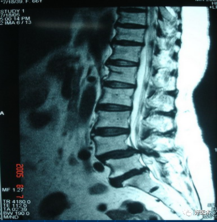 图文精讲：不可忽视的腰痛原因--腰椎滑脱！