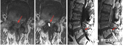 医生阅读腰椎MRI必看的七个征象，基础但不简单！