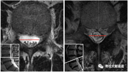 医生阅读腰椎MRI必看的七个征象，基础但不简单！