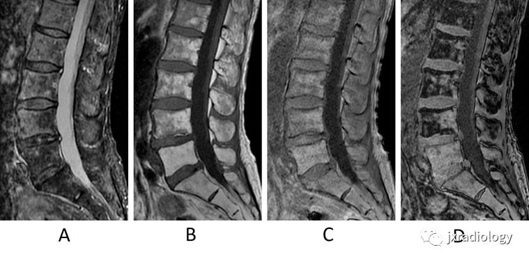 全方位图文精讲：椎体和椎旁信号增高的关键影像诊断！