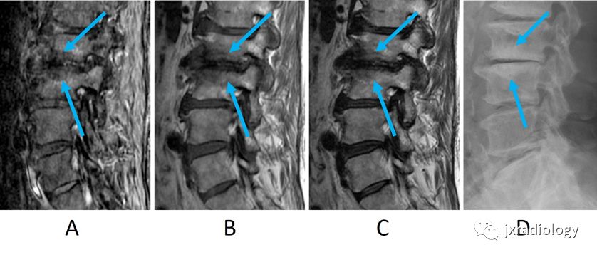 全方位图文精讲：椎体和椎旁信号增高的关键影像诊断！