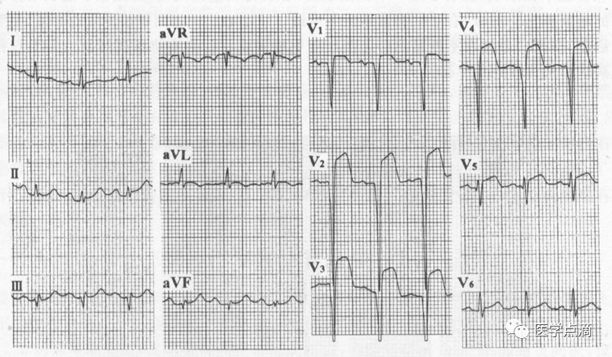 学习心电图必须掌握的基础知识，收藏起来慢慢看！