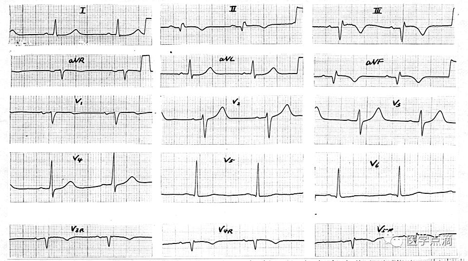学习心电图必须掌握的基础知识，收藏起来慢慢看！