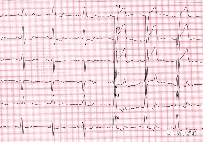 学习心电图必须掌握的基础知识，收藏起来慢慢看！