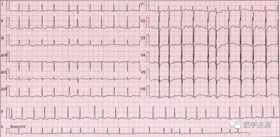 学习心电图必须掌握的基础知识，收藏起来慢慢看！