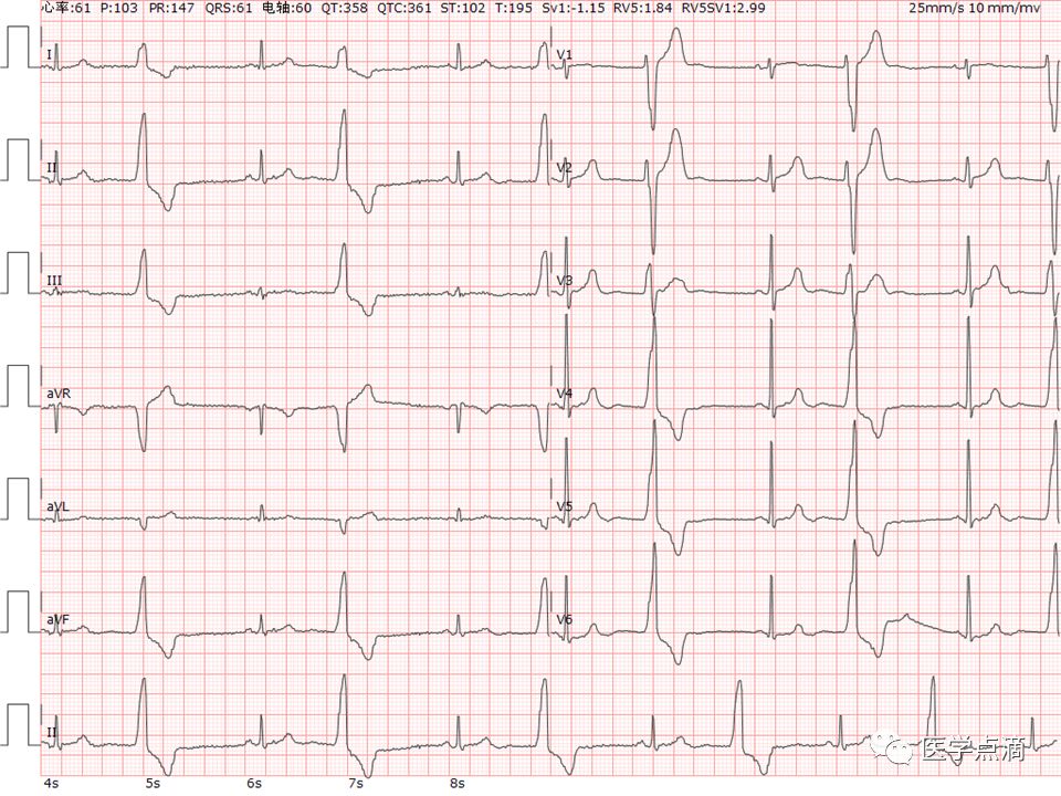 学习心电图必须掌握的基础知识，收藏起来慢慢看！