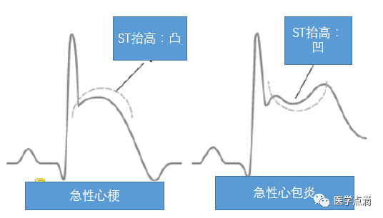 学习心电图必须掌握的基础知识，收藏起来慢慢看！