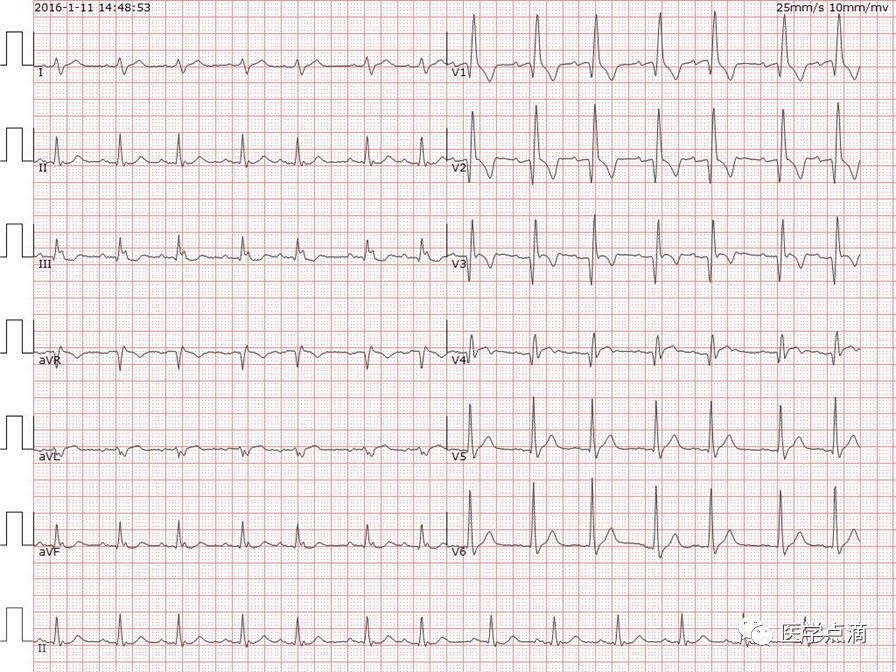 学习心电图必须掌握的基础知识，收藏起来慢慢看！