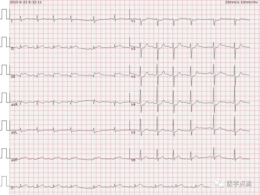 学习心电图必须掌握的基础知识，收藏起来慢慢看！