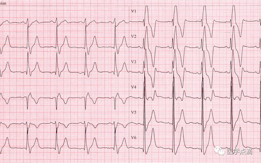 学习心电图必须掌握的基础知识，收藏起来慢慢看！