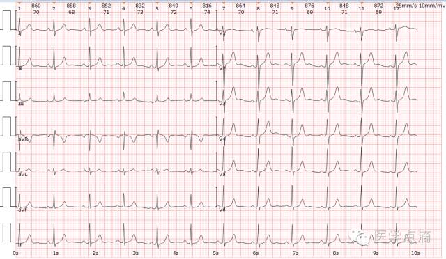 学习心电图必须掌握的基础知识，收藏起来慢慢看！