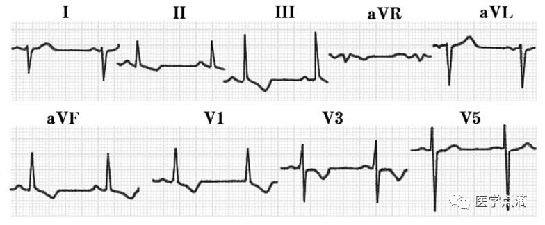 学习心电图必须掌握的基础知识，收藏起来慢慢看！