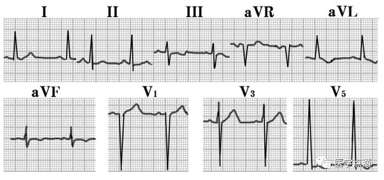 学习心电图必须掌握的基础知识，收藏起来慢慢看！