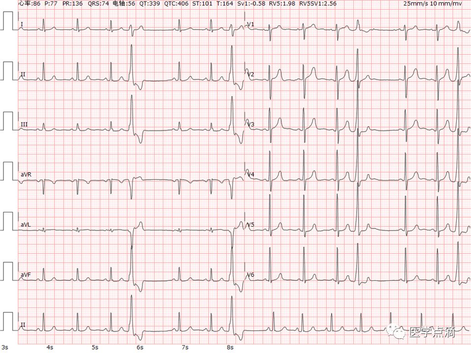 学习心电图必须掌握的基础知识，收藏起来慢慢看！