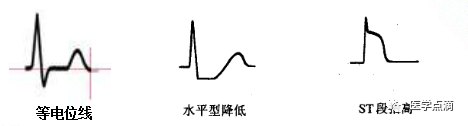 学习心电图必须掌握的基础知识，收藏起来慢慢看！