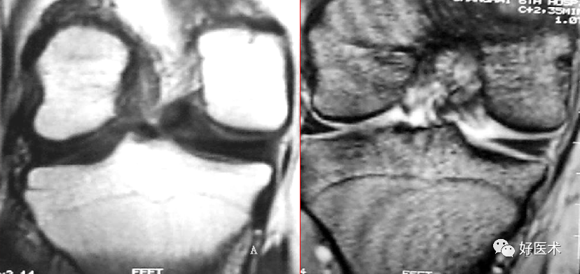 层层深入图文详解半月板MRI解剖诊断，必备收藏贴！