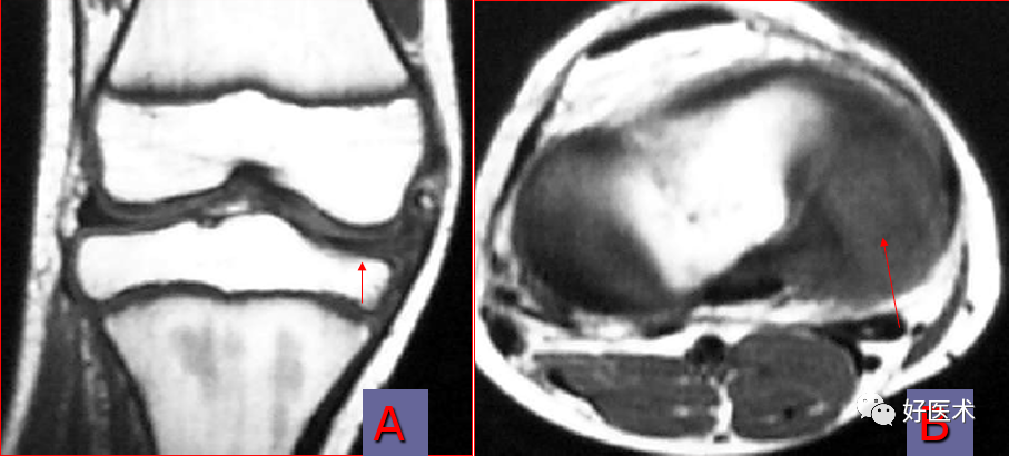 层层深入图文详解半月板MRI解剖诊断，必备收藏贴！