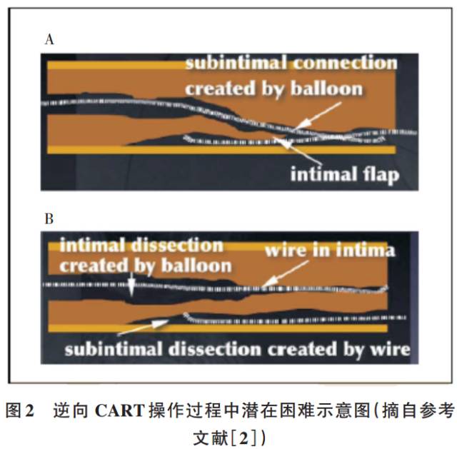 逐步了解逆向CART技术，来一份专家经验！