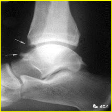 高清组图学踝关节韧带及相关影像诊断，想忘记都难！