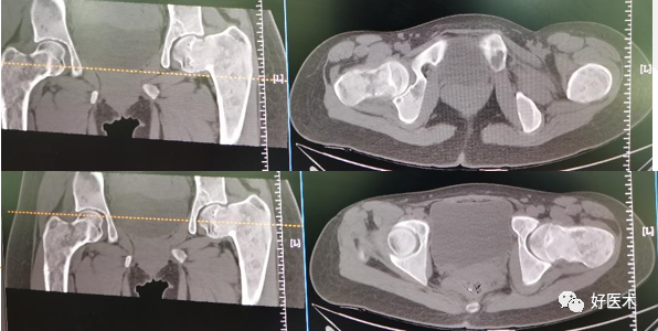 从影像诊断到手术治疗，全面讲解主任口中的“骨纤”！