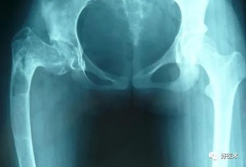 从影像诊断到手术治疗，全面讲解主任口中的“骨纤”！