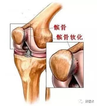 高手进阶：90%的膝关节疼痛都能在本文中找到答案！