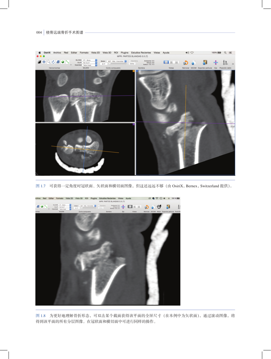 新书首发|《桡骨远端骨折手术图谱》，临床医生必备专著！