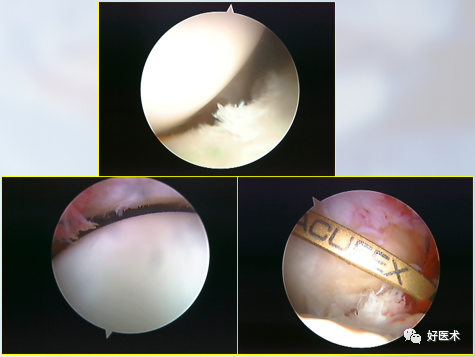 关节镜技术速成诀窍，请收下这份详细说明书！