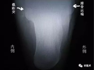 138张高清图全面记录精讲，快速拿下跟骨骨折手术！