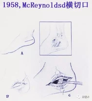 138张高清图全面记录精讲，快速拿下跟骨骨折手术！