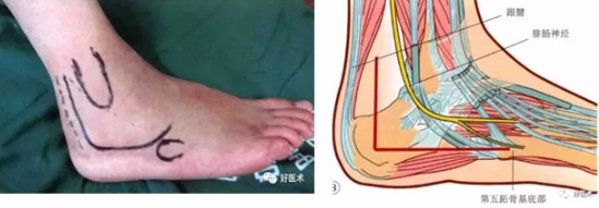 138张高清图全面记录精讲，快速拿下跟骨骨折手术！
