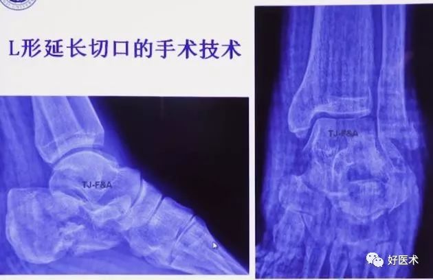 138张高清图全面记录精讲，快速拿下跟骨骨折手术！