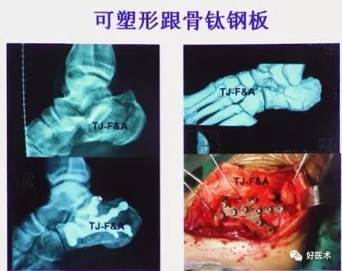 138张高清图全面记录精讲，快速拿下跟骨骨折手术！