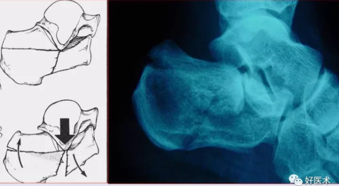 138张高清图全面记录精讲，快速拿下跟骨骨折手术！