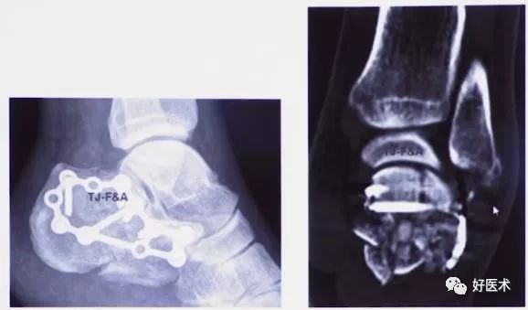 138张高清图全面记录精讲，快速拿下跟骨骨折手术！