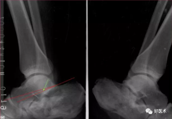 138张高清图全面记录精讲，快速拿下跟骨骨折手术！
