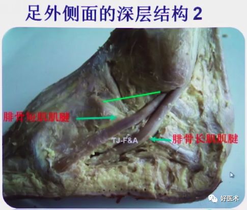 138张高清图全面记录精讲，快速拿下跟骨骨折手术！