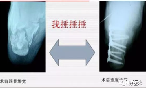 138张高清图全面记录精讲，快速拿下跟骨骨折手术！