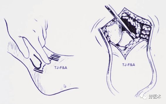 138张高清图全面记录精讲，快速拿下跟骨骨折手术！
