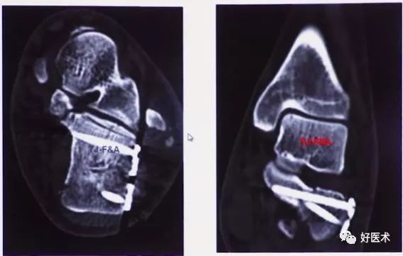 138张高清图全面记录精讲，快速拿下跟骨骨折手术！