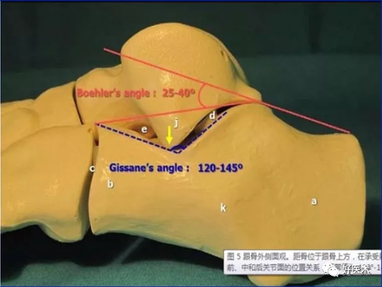 138张高清图全面记录精讲，快速拿下跟骨骨折手术！