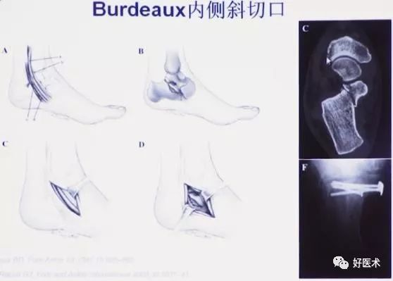 138张高清图全面记录精讲，快速拿下跟骨骨折手术！