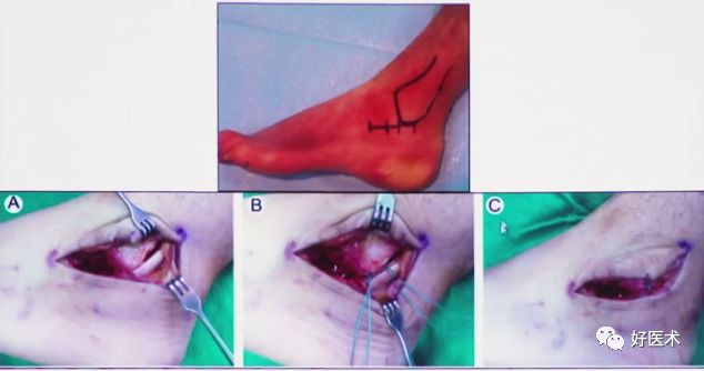138张高清图全面记录精讲，快速拿下跟骨骨折手术！