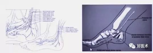 138张高清图全面记录精讲，快速拿下跟骨骨折手术！