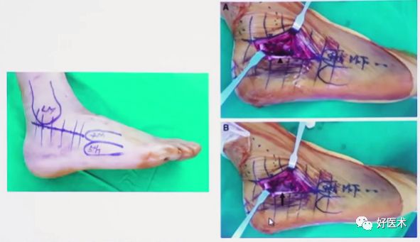138张高清图全面记录精讲，快速拿下跟骨骨折手术！